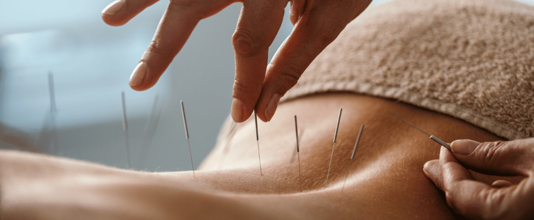 acupuncture