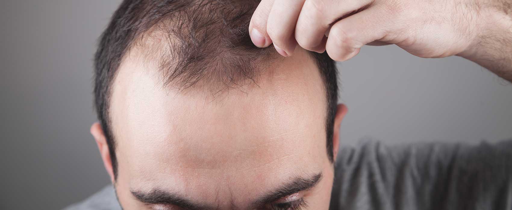 balding man