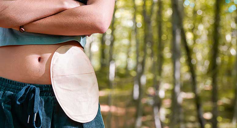 person outdoors with ostomy pouch