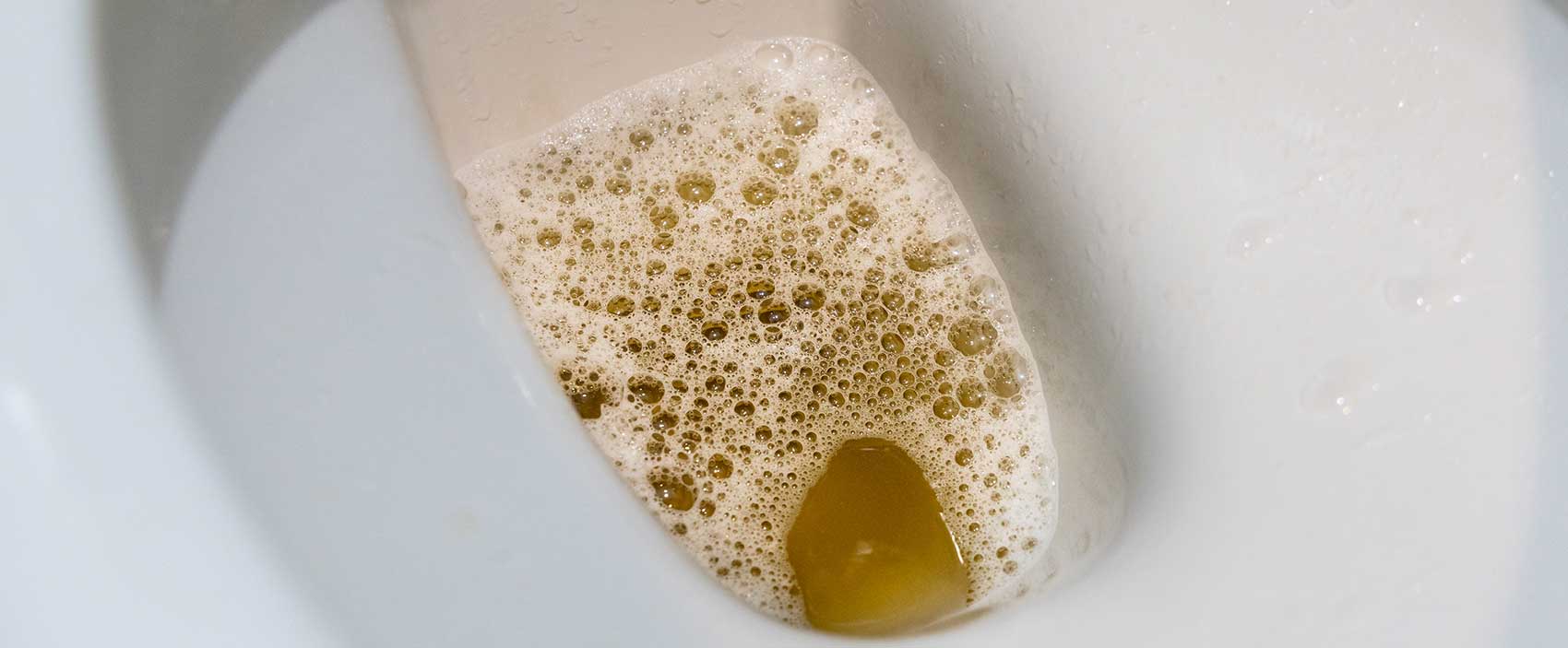 foamy urine in toilet bowl