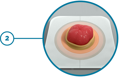 Step 2 Skin Barrier Around Stoma