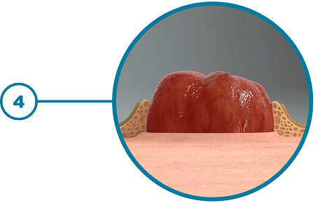 Step 4 Snug Fit Around Stoma