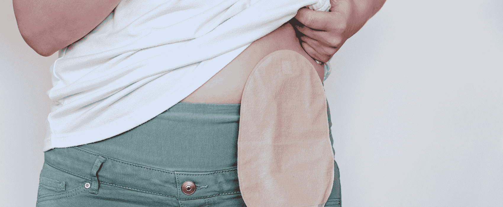 ostomy and stoma output