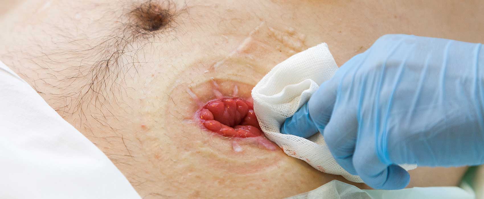 stoma retraction