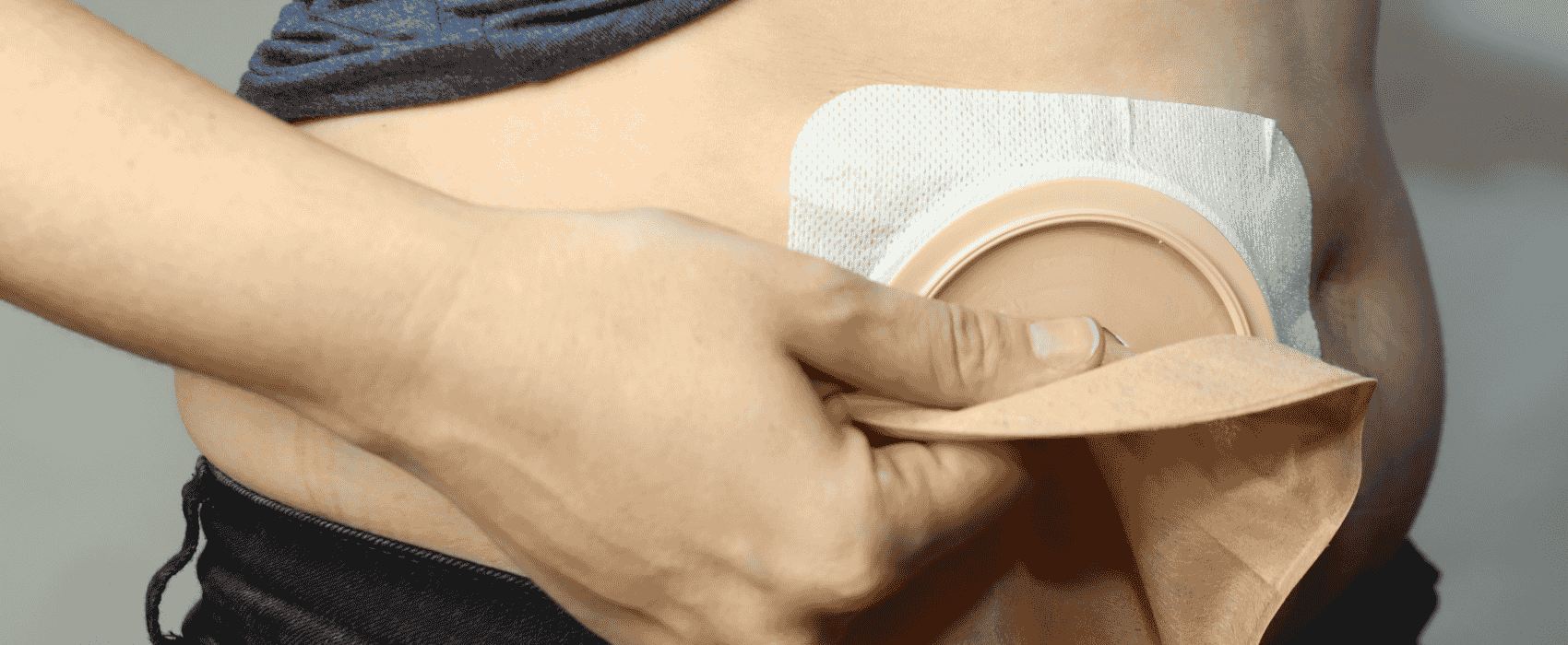 temporary ostomy
